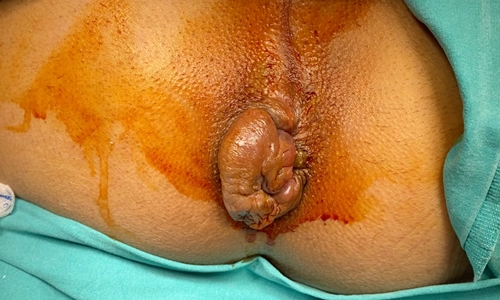 Tromboze Eksternal + İnternal Hemoroidal Hastalık (Miks Tip)