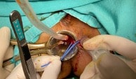 Hemoroid Ameliyatı Sonrası Gelişen Anal Apse