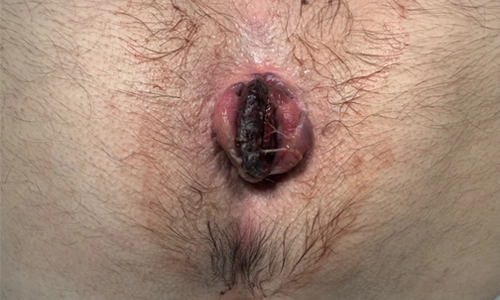 Tromboze İnternal Hemoroidal Hastalık