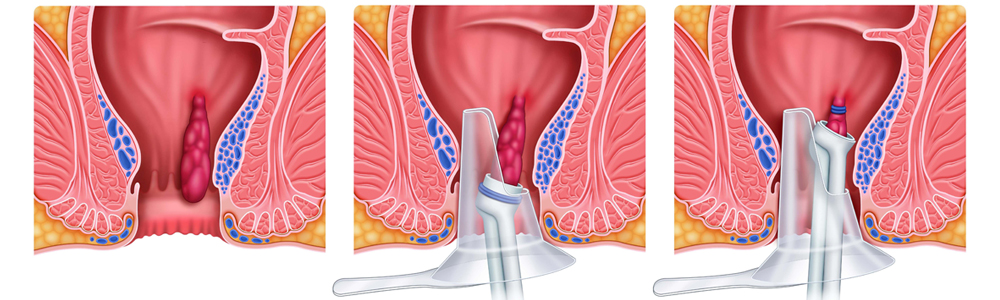 Klasik Hemoroid Ameliyatı Nasıl Yapılır?