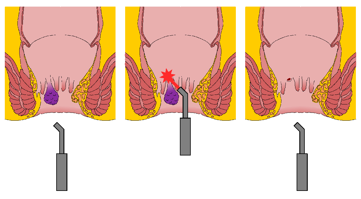 Lazerle Hemoroid Tedavisi Nasıl Yapılır?