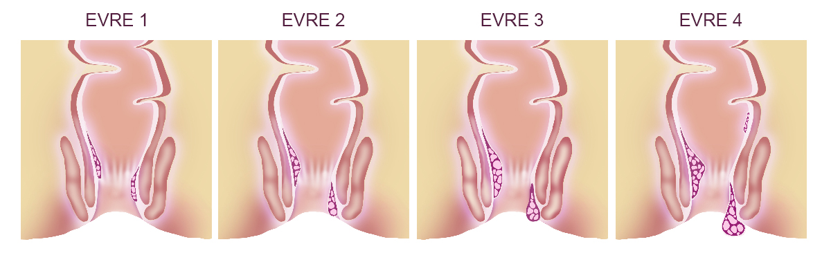 Lazerle Hemoroid Tedavisi Nedir?